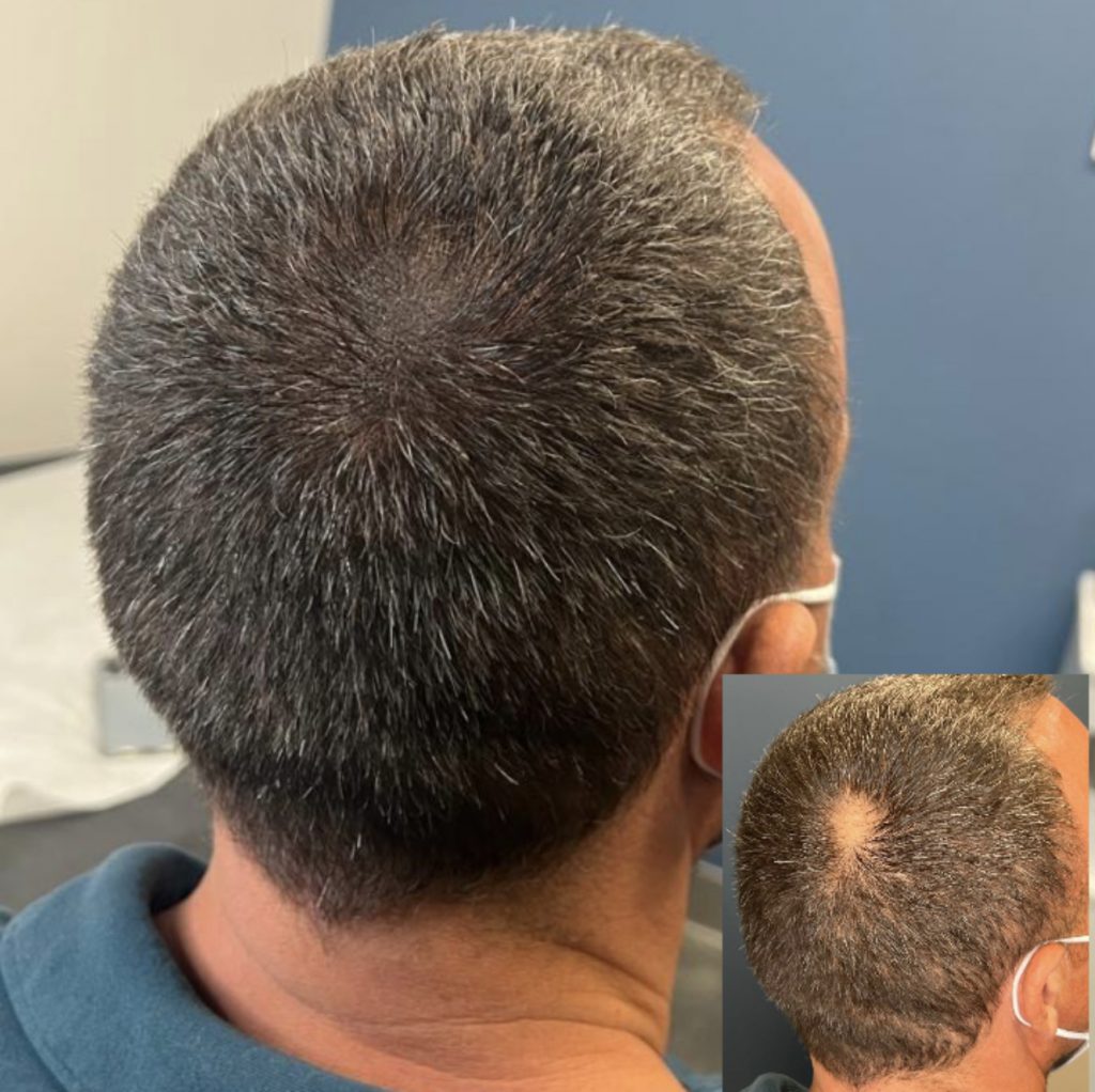 bald spot micropigmentation